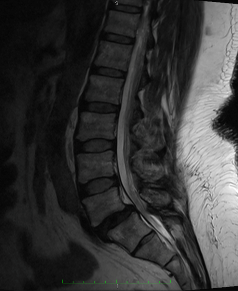 An MRI of the lower part of the spine.
