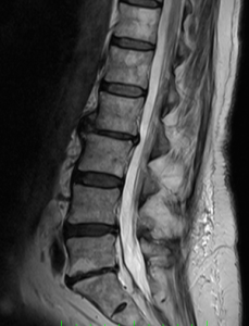 An MRI of the spine