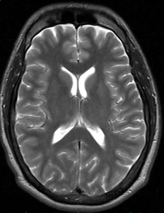 An MRI of the brain